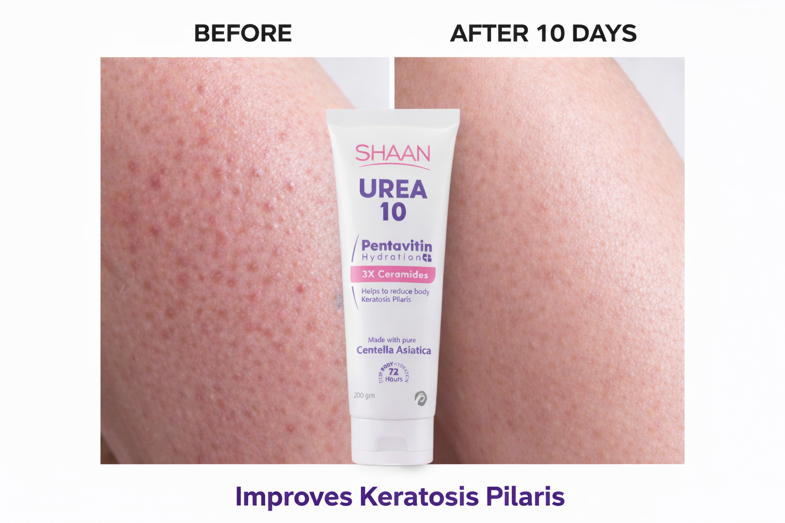 Shaan Urea 10% Body Moisturizer 200 Gm