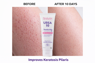 Before and after comparison of a tube of Shaan Urea 10 cream on skin with keratosis pilaris.