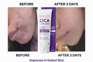 Before and after comparison of skin irritation with a bottle of Shaan Cica Cream.