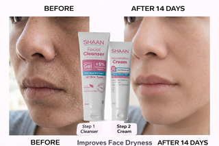 Before and after comparison of facial skin with  shaan skincare products.