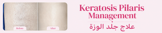 Shaan Urea Product 'Before' and 'After' comparison, featuring text on Keratosis Pilaris Management.