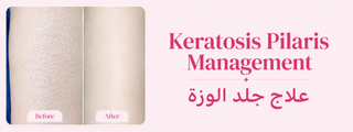 Shaan Urea Product 'Before' and 'After' comparison, featuring text on Keratosis Pilaris Management.