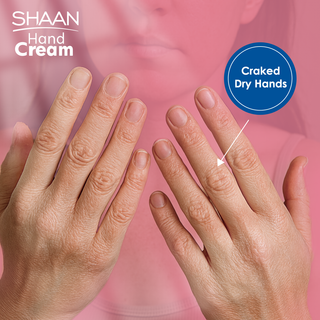 Hands with cracked dry skin showing the need for hand cream, with 'Shaan Hand Cream' branding.